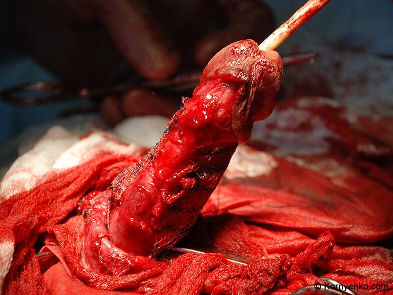 instalarea unei matrice de colagen pentru mărirea penisului