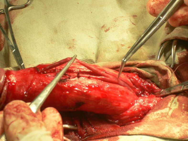 lipofilling a penisului pentru mărire