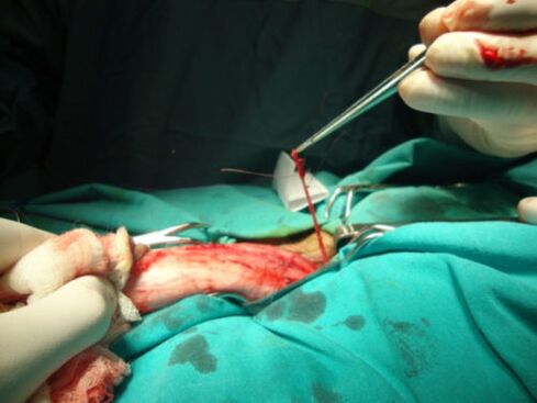 operatie de marire a penisului