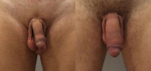 înainte și după operația de mărire a penisului